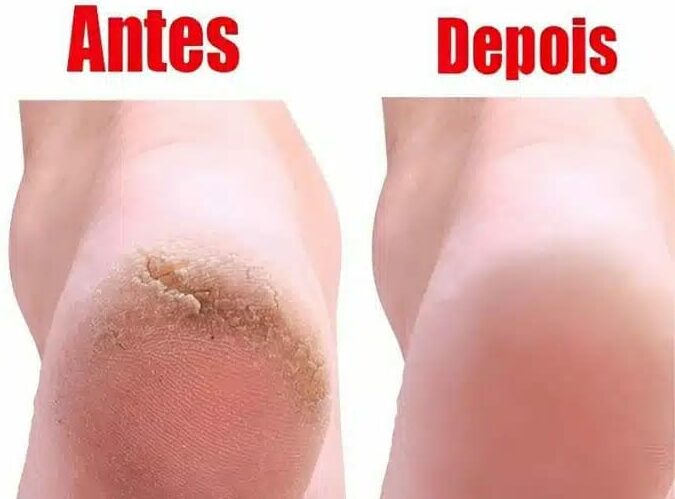 Deixar seus Pés Lisos e Hidratados de Forma Fácil