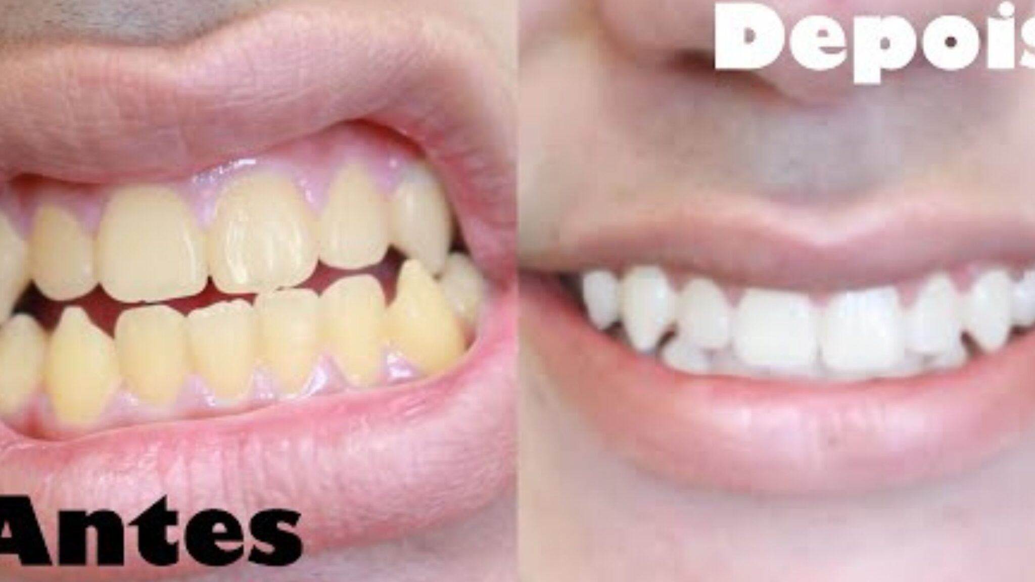 Receita caseira para clarear os dentes, fácil e eficaz