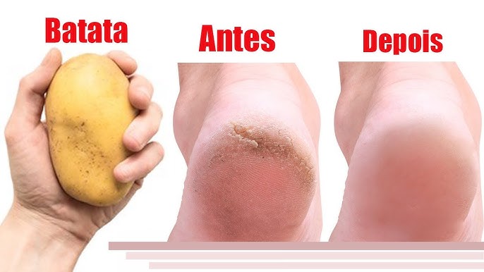 Diga adeus as rachaduras nos pés usando batata