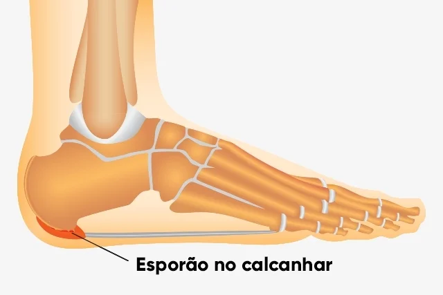 Aprenda a acabar com o esporão do calcanhar de forma simples