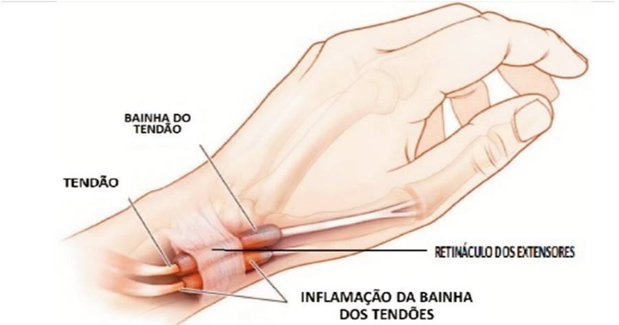 dores persistentes nas mãos e nos pés